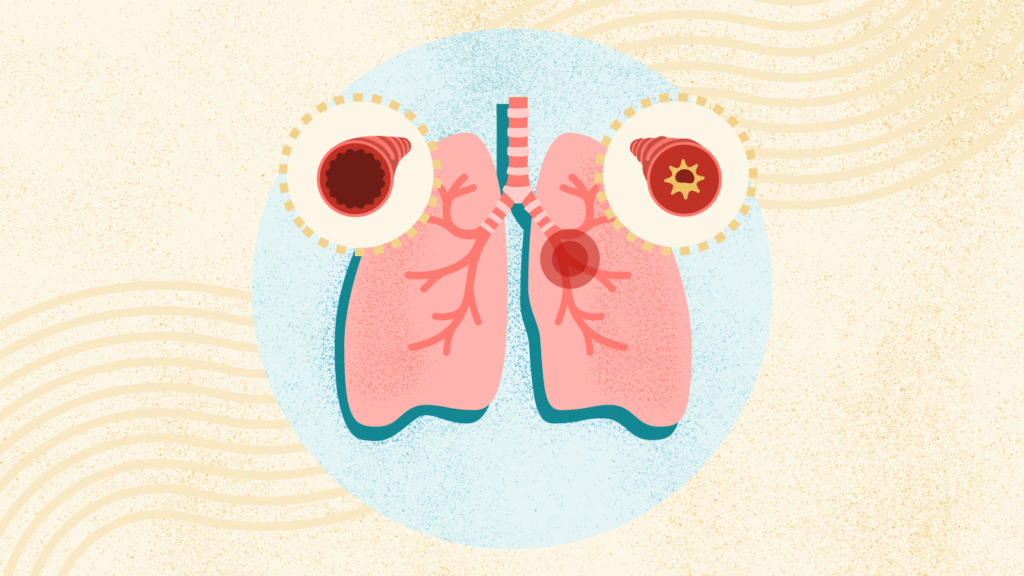 Asthma Symptoms, Causes, And Treatments