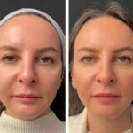 Top Benefits of Choosing Mesotherapy Treatments in Dubai for Skin Rejuvenation