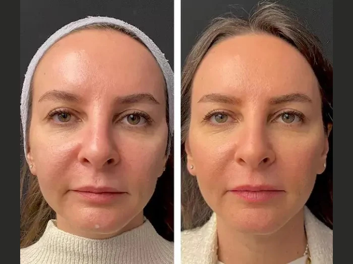 Top Benefits of Choosing Mesotherapy Treatments in Dubai for Skin Rejuvenation