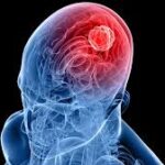 Understanding Glioblastoma Cancer in India: Causes, Symptoms, and Diagnosis