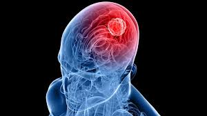 Understanding Glioblastoma Cancer in India: Causes, Symptoms, and Diagnosis