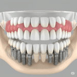 Full Dental Implants