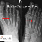 hairline fracture on foo