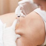 What Areas Can fat-melting injections treat safely?