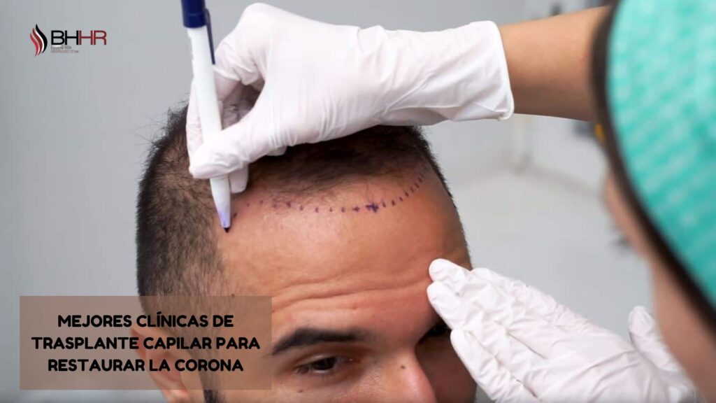 clinicas de implante capilar
