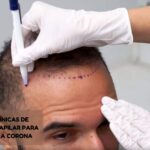 clinicas de implante capilar