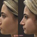 Nonsurgical Rhinoplasty in Islamabad: Safe, Simple, Stunning