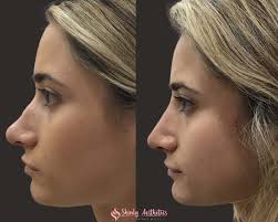 Nonsurgical Rhinoplasty in Islamabad: Safe, Simple, Stunning