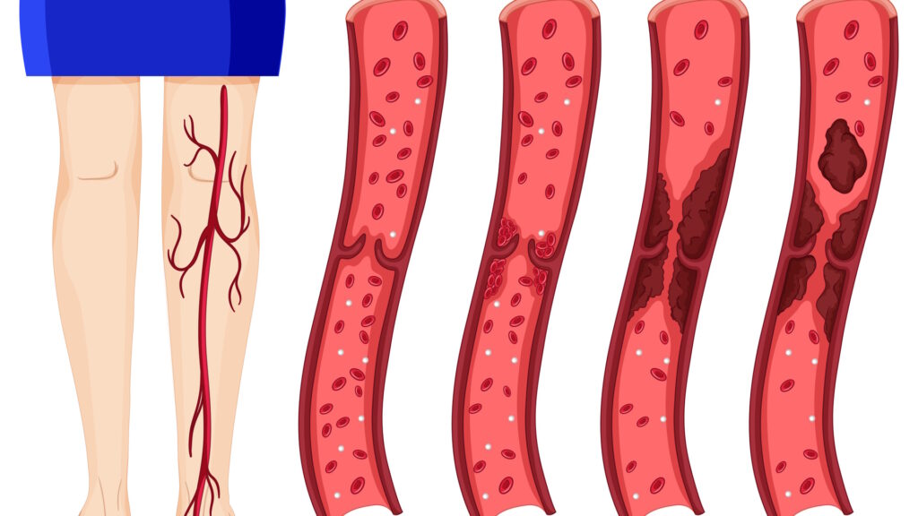 blood clot in leg symptoms