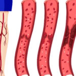 blood clot in leg symptoms