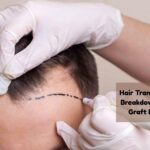 hair transplant price