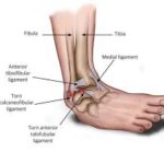 managing ligament strain with soma medicine