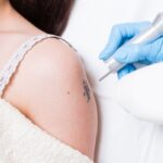 Say Goodbye to Unwanted Ink with Laser Tattoo Removal Treatment in Islamabad