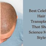 best celebrity hair transplants