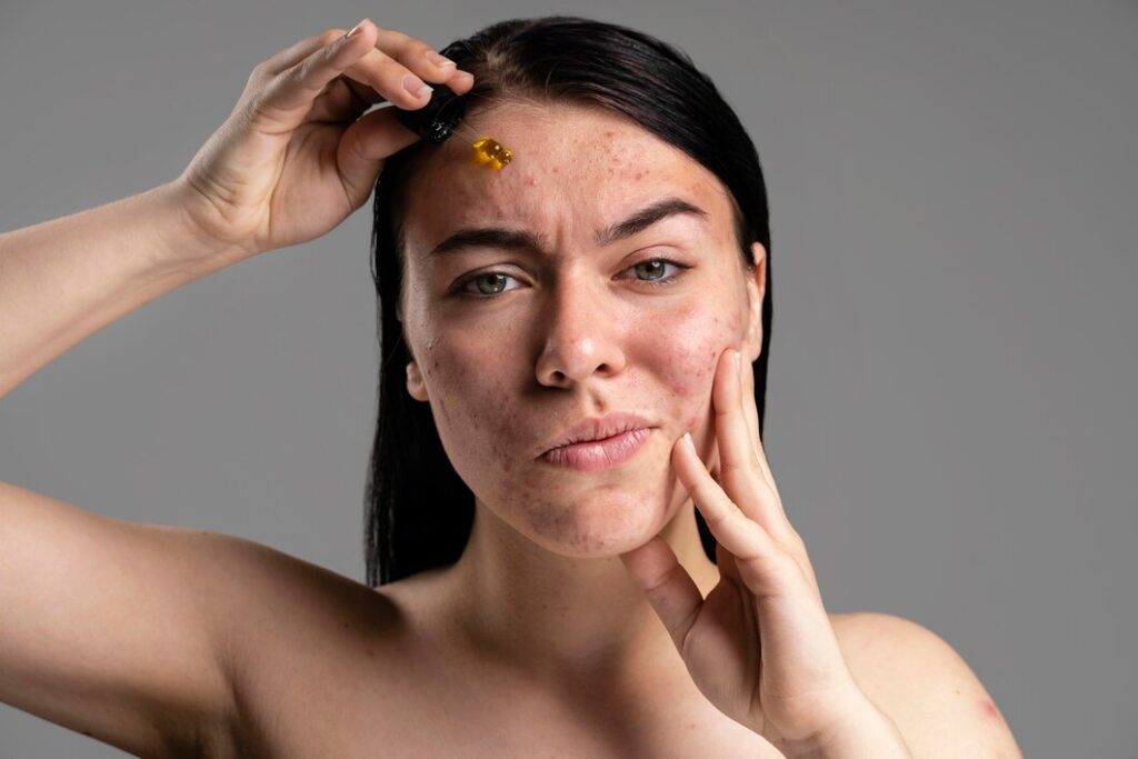 Reveal Your Best Skin: Acne Scar Removal in Beverly Hills