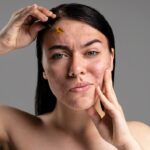 Reveal Your Best Skin: Acne Scar Removal in Beverly Hills