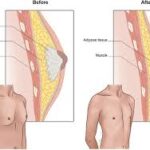 Top Benefits of Gynecomastia Surgery for Men’s Confidence and Appearance
