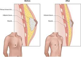 Top Benefits of Gynecomastia Surgery for Men’s Confidence and Appearance