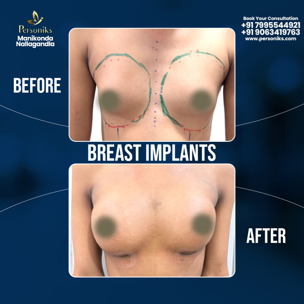 Top-Rated Breast Implants in Hyderabad – Affordable, Safe & Expert Care at Personiks (2025 Guide)